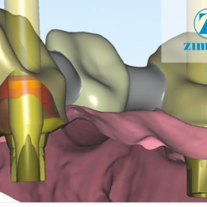 Zfx™ Abutment Designer - Software Upgrade