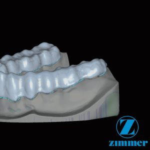 Zfx™ Bite Splint - Software Upgrade