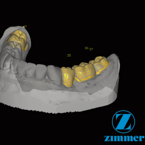 Zfx™ Provisional Crown&Bridges - Software Upgrade